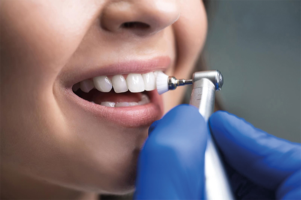 How-Often-Should-Teeth-Cleaning-Be-Performed?