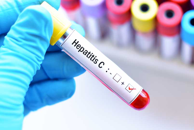 Hepatit C Pozitif