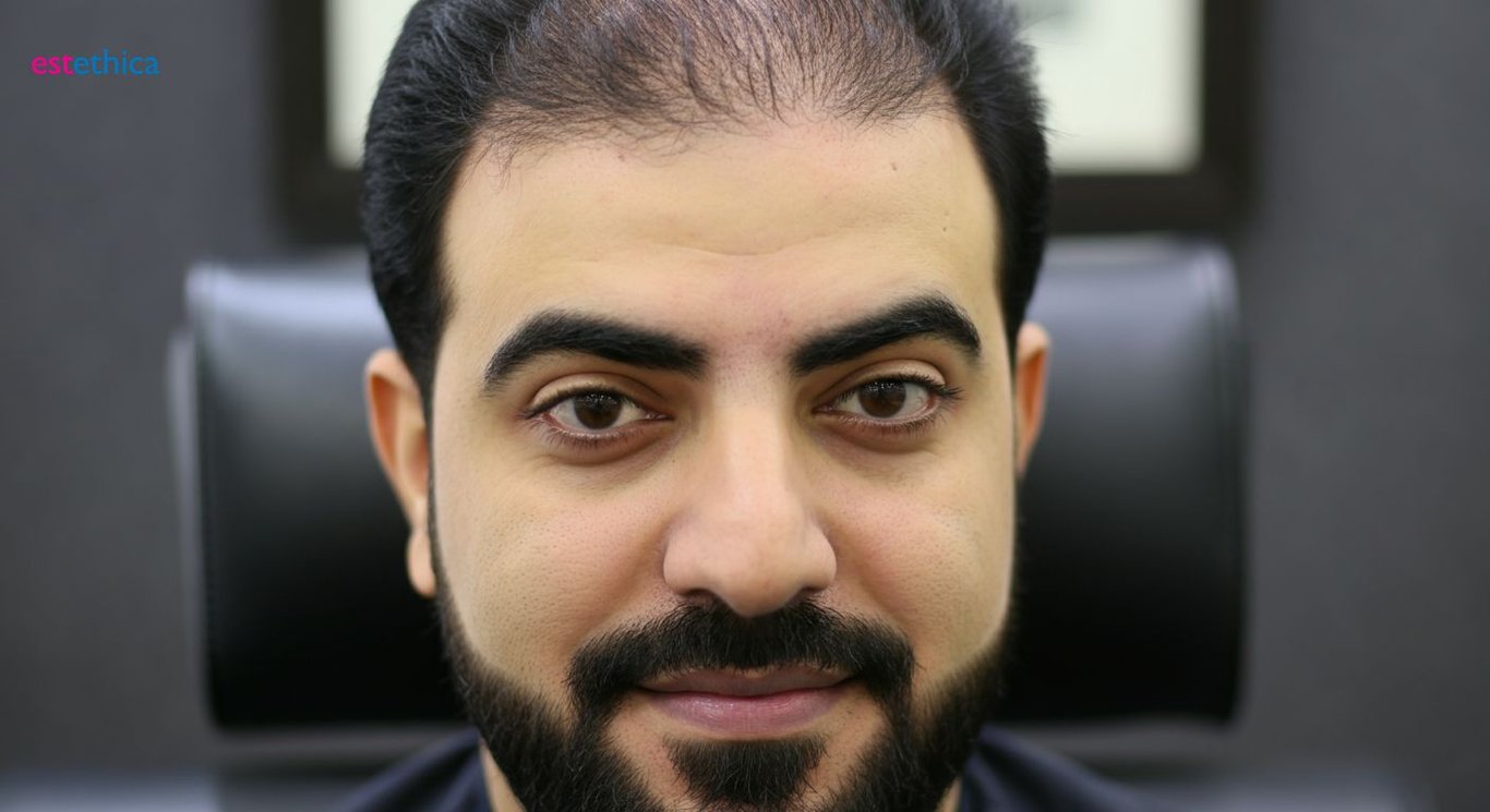 هل زراعة الشعر مؤلمة؟ معلومات قبل العملية
