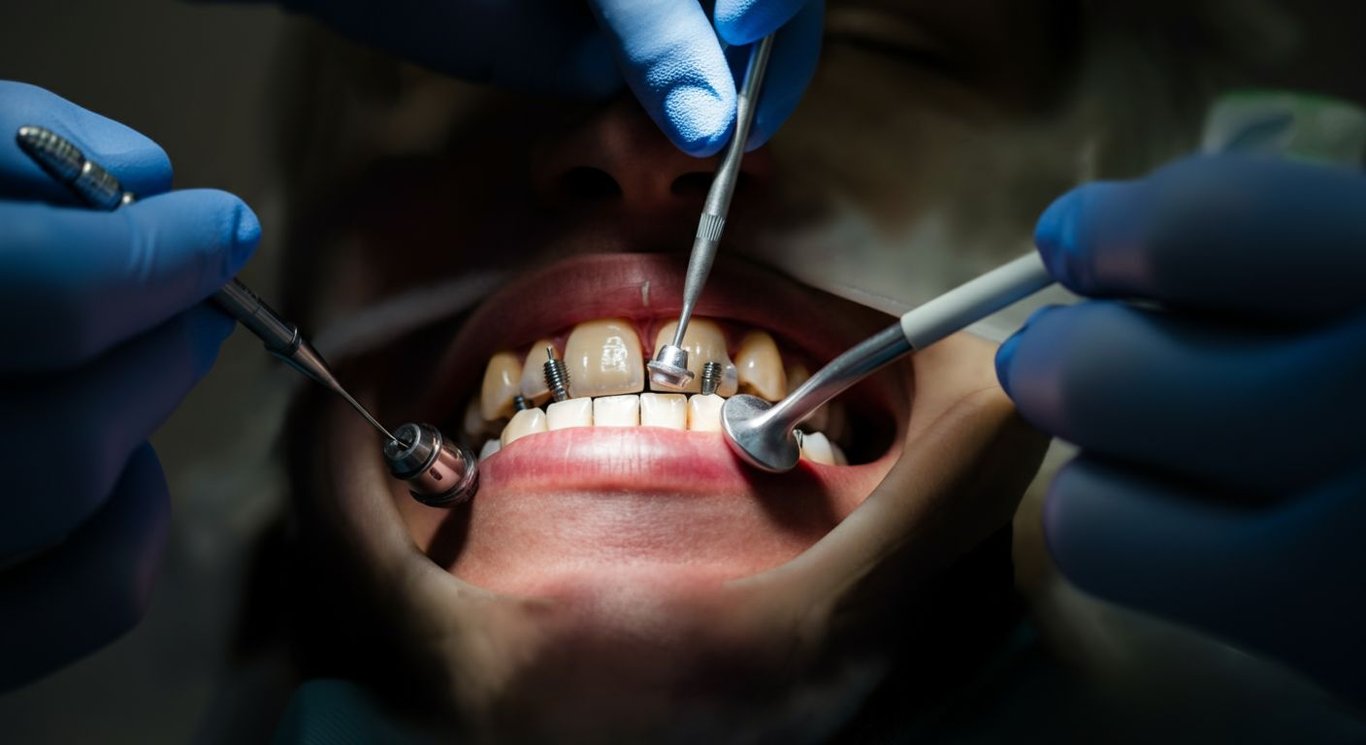 Dental Implants vs. Dental Bridges comparison image