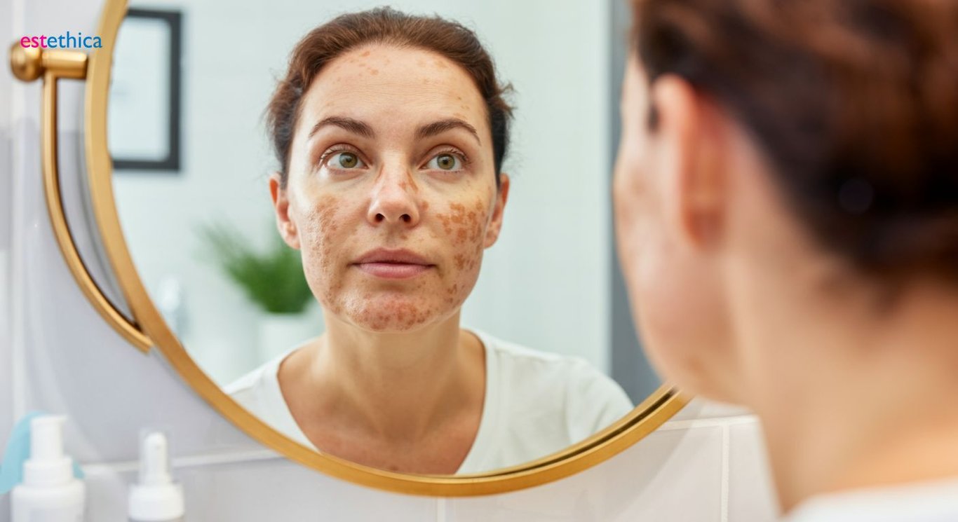 Lazerle leke tedavisi: acıtır mı, kalıcı mıdır?