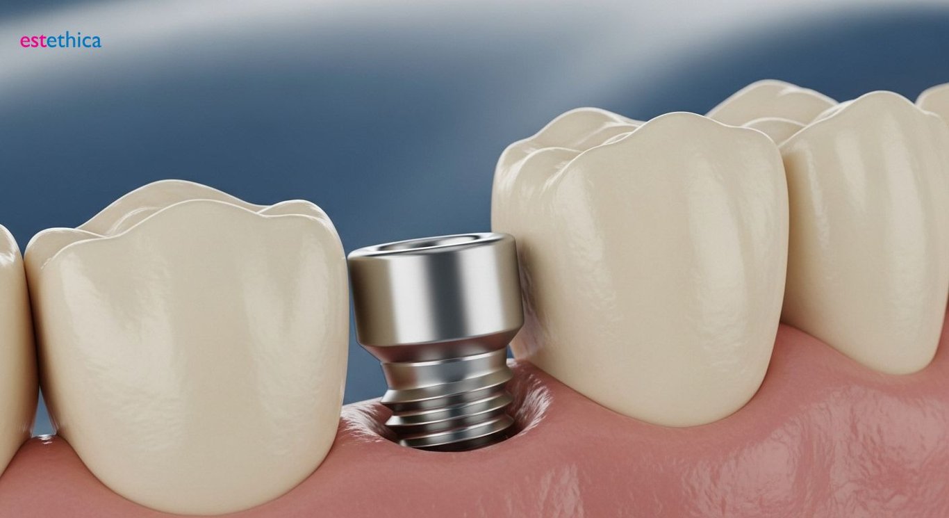Osseointegration process in tooth implants