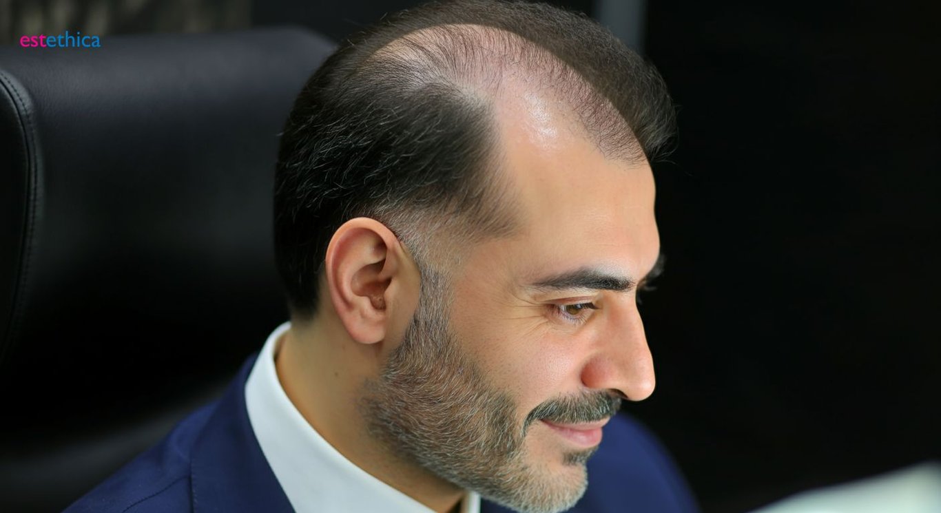 Saç ekim merkezi seçiminde kritik faktörler