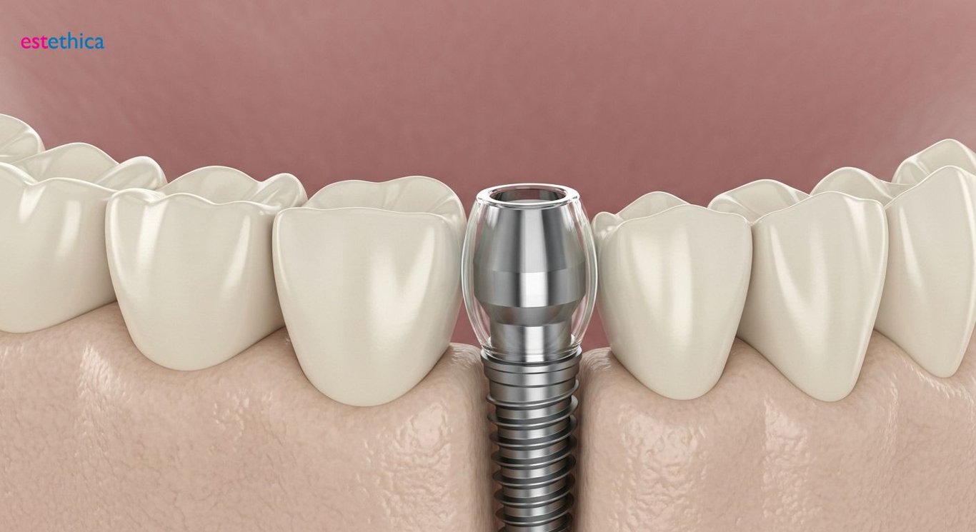 Tooth Implants vs. Dentures: Choosing the Right Solution